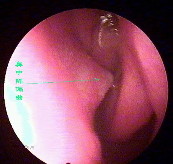 经常流鼻血是鼻中隔偏曲惹的祸