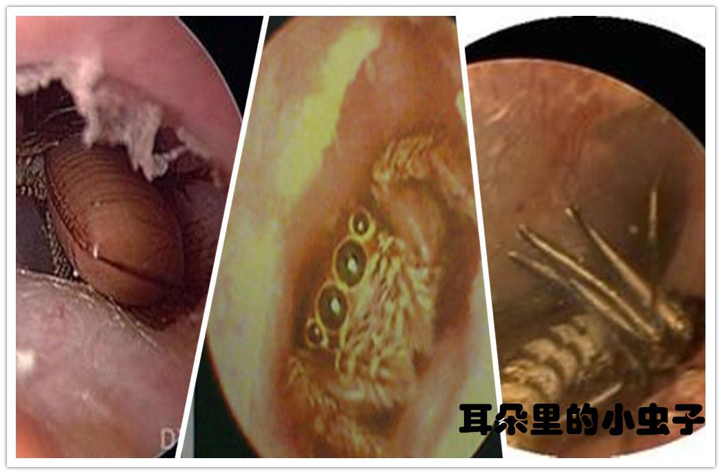 耳内镜下实拍:钻进耳朵的虫子